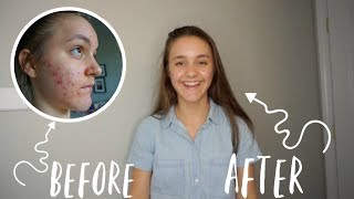 HOW TO GET RID OF ACNE | One month on Doxycycline