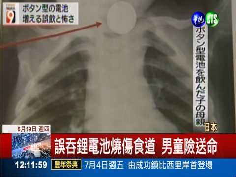 男童誤吞鋰電池 卡食道嚴重燒傷