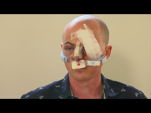 Peaceful Floyd Protester Partially Blinded By Non-Lethal Projectile