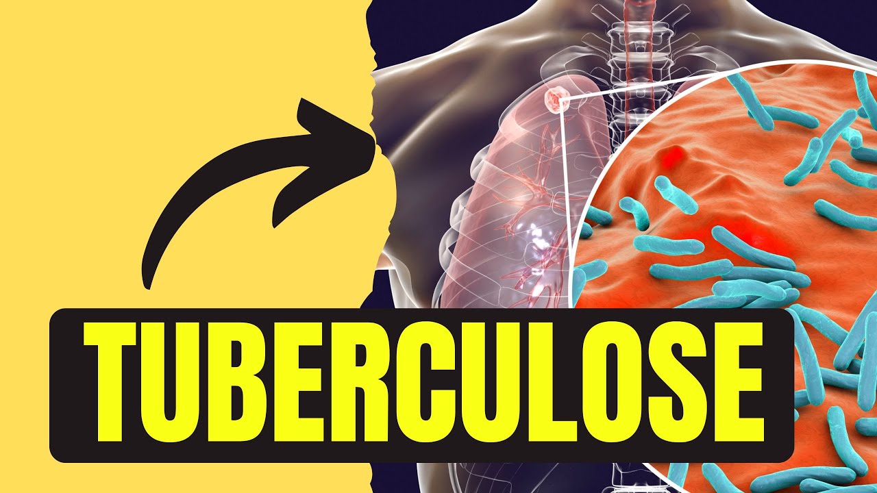 TUBERCULOSE - ESQUEMA DE TRATAMENTO (PARTE 2)