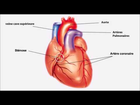 Une impulsion tendue dur est observée dans une crise hypertensive Gousses de traitement de lhypertension