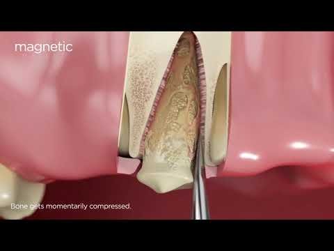 Kit Essential introduction — animated overview of magnetodynamic periotomy