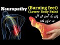 Peripheral Neuropathic Pain Burning Feet And Neuropathic Pain Causes And Symptoms In Urdu Hindi