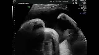 Asvide: The fetal hands were persistently maintained in an extended position in utero, showing no...