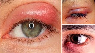 How to Get Rid of an Eye Infection at Home.