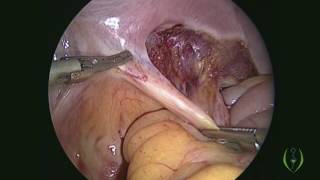 Laparoscopic Radical Hysterectomy with Pelvic Lymph Node Dissection