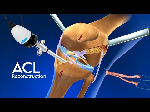 ACL Reconstruction Surgery : 3D Animation | The Scopic Vision 