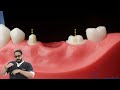 Parallel Tooth Preparation For A Multi Unit Bridge