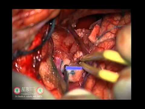 Optic Nerve Glioma