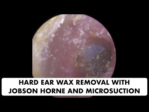 HARD EAR WAX REMOVAL WITH JOBSON HORNE AND MICROSUCTION - Ep 20