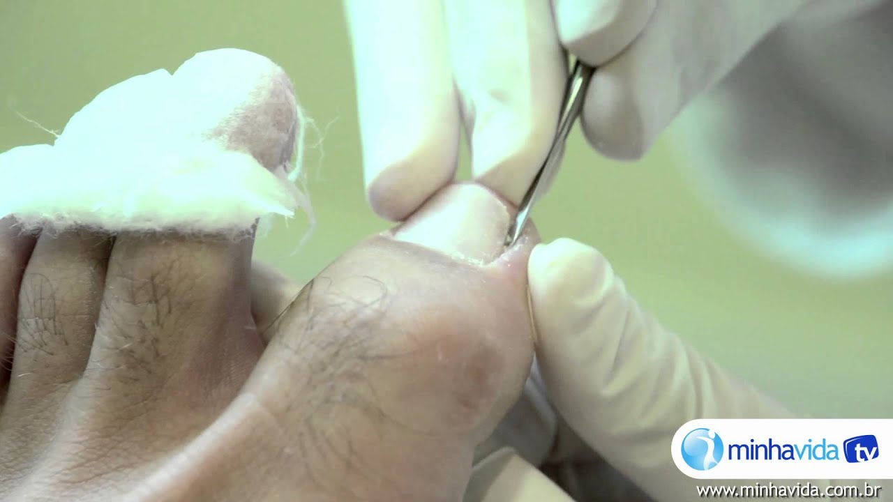 Pé diabético: pessoas com diabetes devem ter cuidados especiais