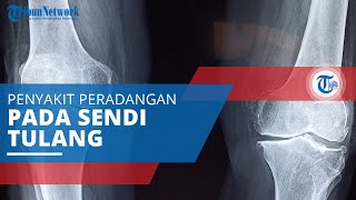 Ankylosing Spondylitis, Penyakit Peradangan pada Sendi yang Sering Mengenai Sendi Tulang Belakang