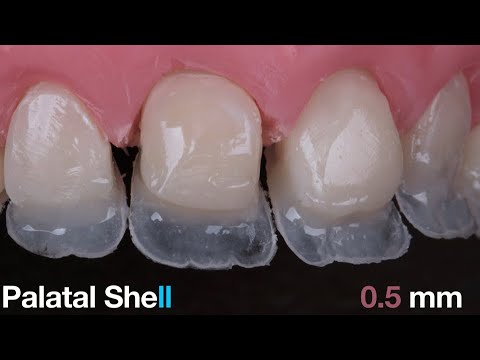 How To Make Palatal Shell Using Silicone Index ?