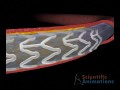 Medical Animation - Drug eluting stent