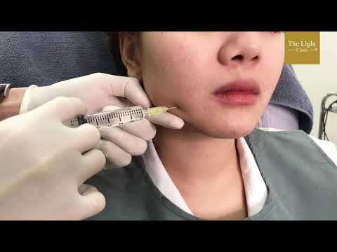 เมโส แฟต