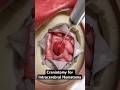 Removing Pooled Blood From The Brain 3D Animation