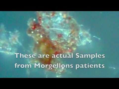 blood for mold test or Microscope Real Delusion? Under the MORGELLONS blood for mold test or Microscope Real Delusion? Under the MORGELLONS