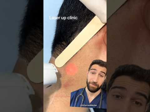 Laser Hair Removal is Surprisingly Clever