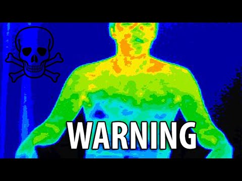 ETS Hyperhidrosis Surgery - The Surgery that RUINED my life - Sympathectomy #hyperhidrosis