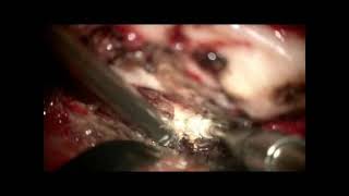 Download Lagu Clinoid meningioma recurrent, dissecting encase arteries from tumor. Agung Budi Sutiono, MD, PhD Thumbnail