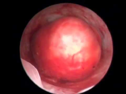 comment traiter un fibrome de 5 cm