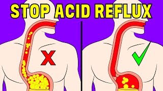 The 4 minute natural trick to prevent acid reflux in the oesophagus