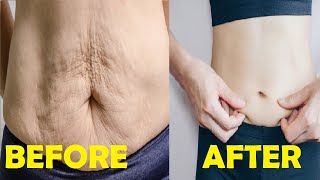 how to get rid of excess skin on stomach in only a few minutes