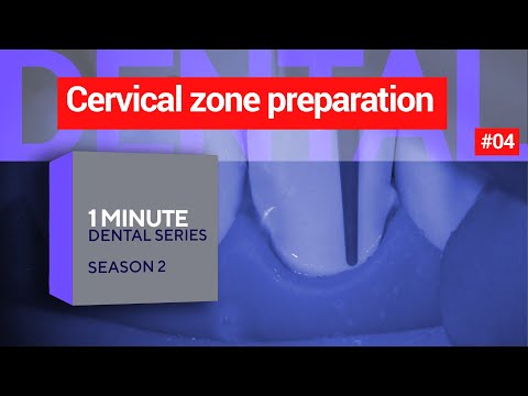 Cervical Zone Preparation Respecting Zenith Point