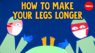 How does leg lengthening surgery work? - Jason Shih Hoellwarth