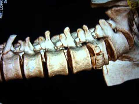 La grande articolazione punta è mal urto Larkspur con ernia intervertebrale