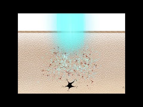 K-Laser Blue Derma - Microcrusting mechanism of action on pigmented lesions