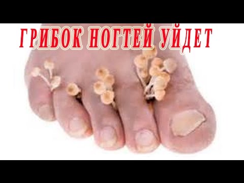 Die Behandlung vom Pech nogtewogo gribka Ob man gestartet gribok des Nagels heilen kann