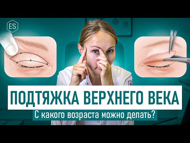 ПОДТЯЖКА ВЕРХНЕГО ВЕКА. С какого возраста можно делать пластику верхних век? — Елена Сухопарова.
