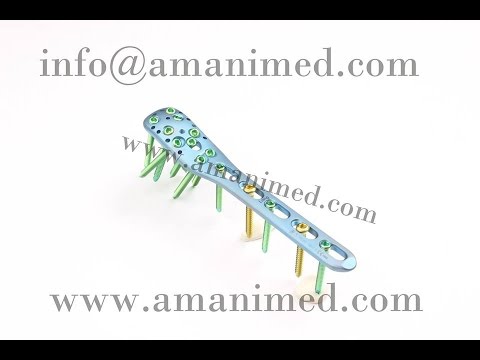 Titanium Bone Plates