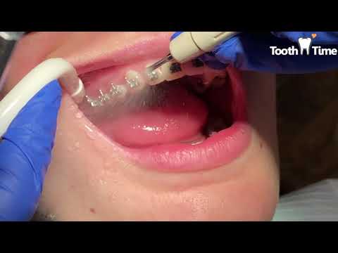 YouTube video about: How do dentists clean teeth with braces?