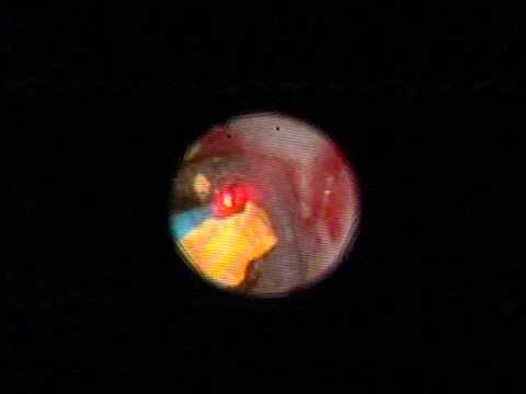 Laser On Kidney Stones