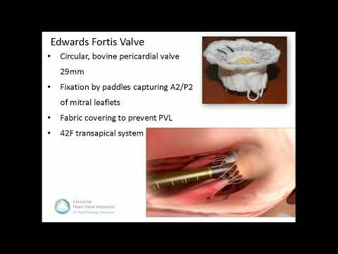 11.00-11.15: Transcatheter Mitral Valve Replacement, Anson Cheung, MD
