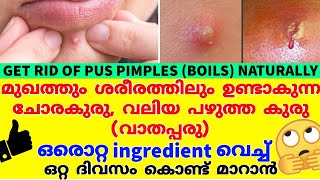 ചോരകുരു,വലിയ കുരുക്കൾ,വാതപ്പരു  മാറാൻ ഒറ്റമൂലി💥Remove Pimple(Boils) Overnight Naturally Malayalam