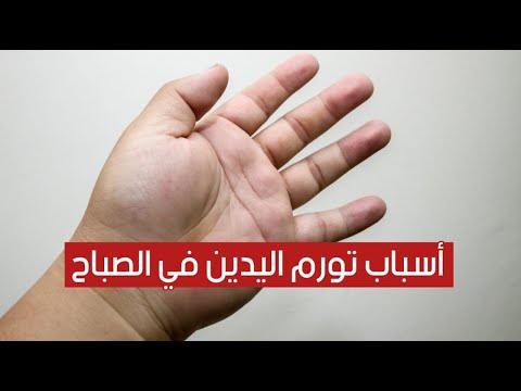 9 أسباب وراء تورم اليدين في الصباح