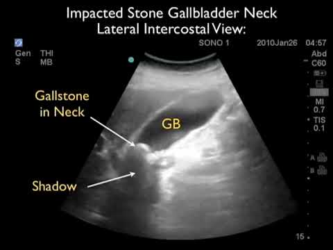 How To: Gallbladder Ultrasound Part 2 - Gallstones Case Study Video