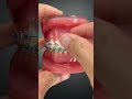Braces Emergency At Home Fixes For Broken Brackets