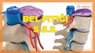 BEL FITIĞI HAKKINDA SIKÇA SORULAN SORULAR