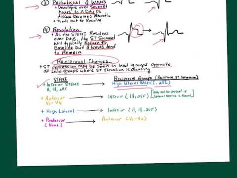 Introduction to STEMI Part III (Posterior wall MI and RVI)