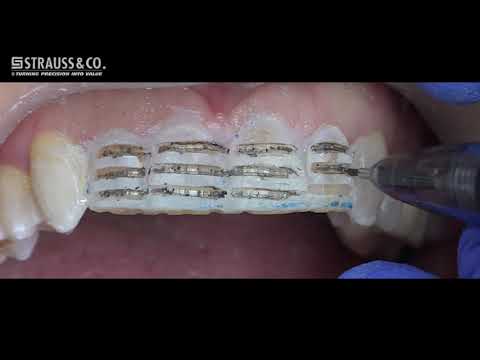 Porcelain Laminate Veneer Preparation Kit by Strauss & Co.