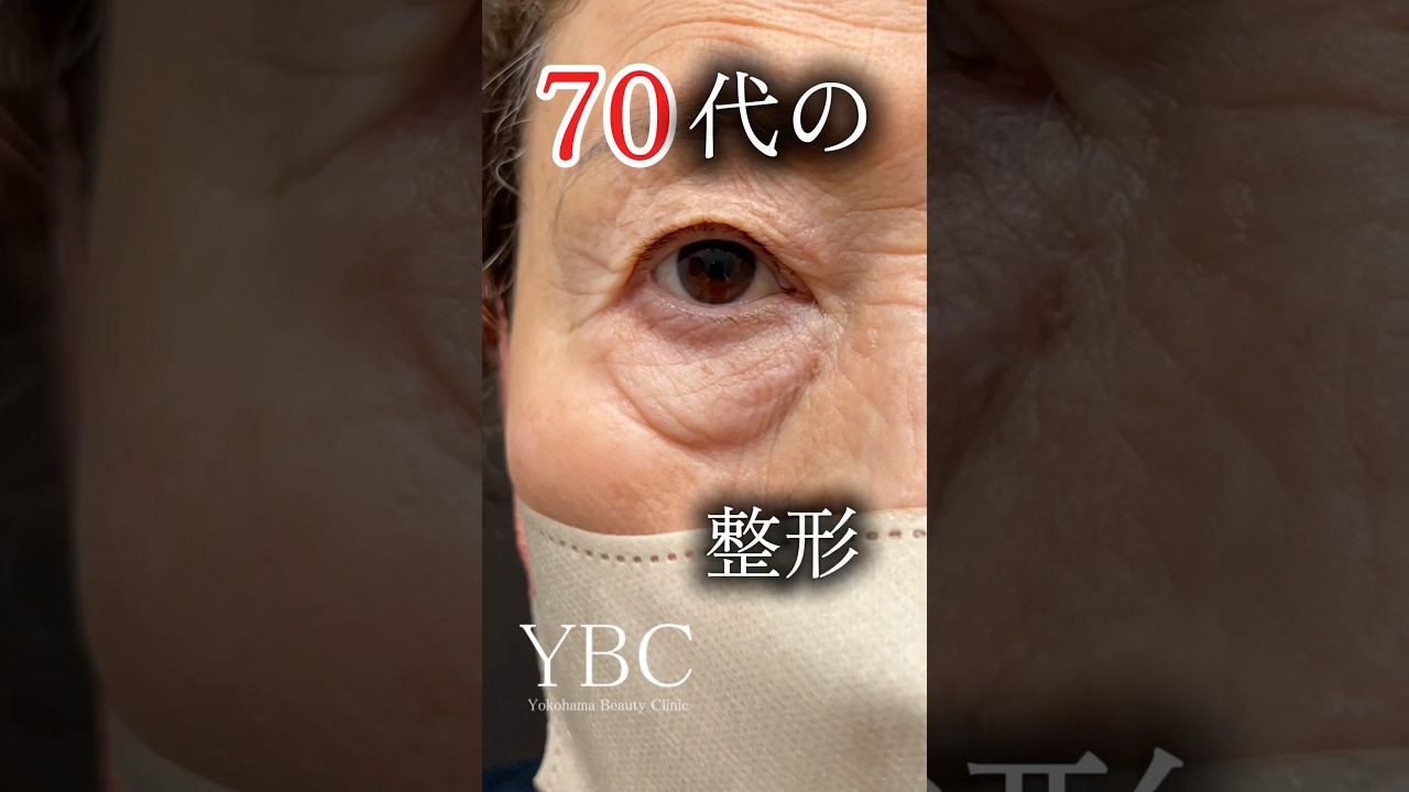 70代の整形#美容 #若返り#クマ取り #目の下のクマ #イソセン#ybc横浜美容外科 #整形