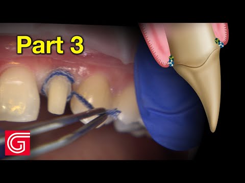 How To Prepare Peg Lateral Tooth #10 Before Digital Scanning - Part 2