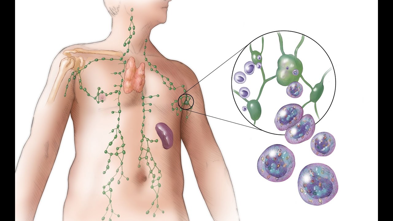 USMLE 1 Hematology 6th (Lymphoma)