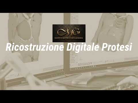 La Sindrome di Poland ed il Pectus Excavatum  Causa, Sintomi e Trattamento