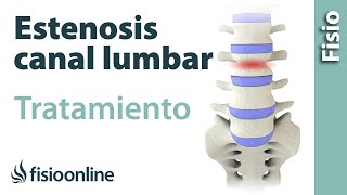 Estenosis de canal lumbar - Causas, síntomas y tratamiento