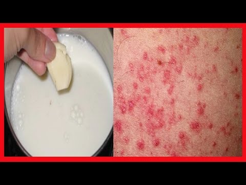 Chi cura la psoriasi un appezzamento Dermatite di atopic del neonato della ragione
